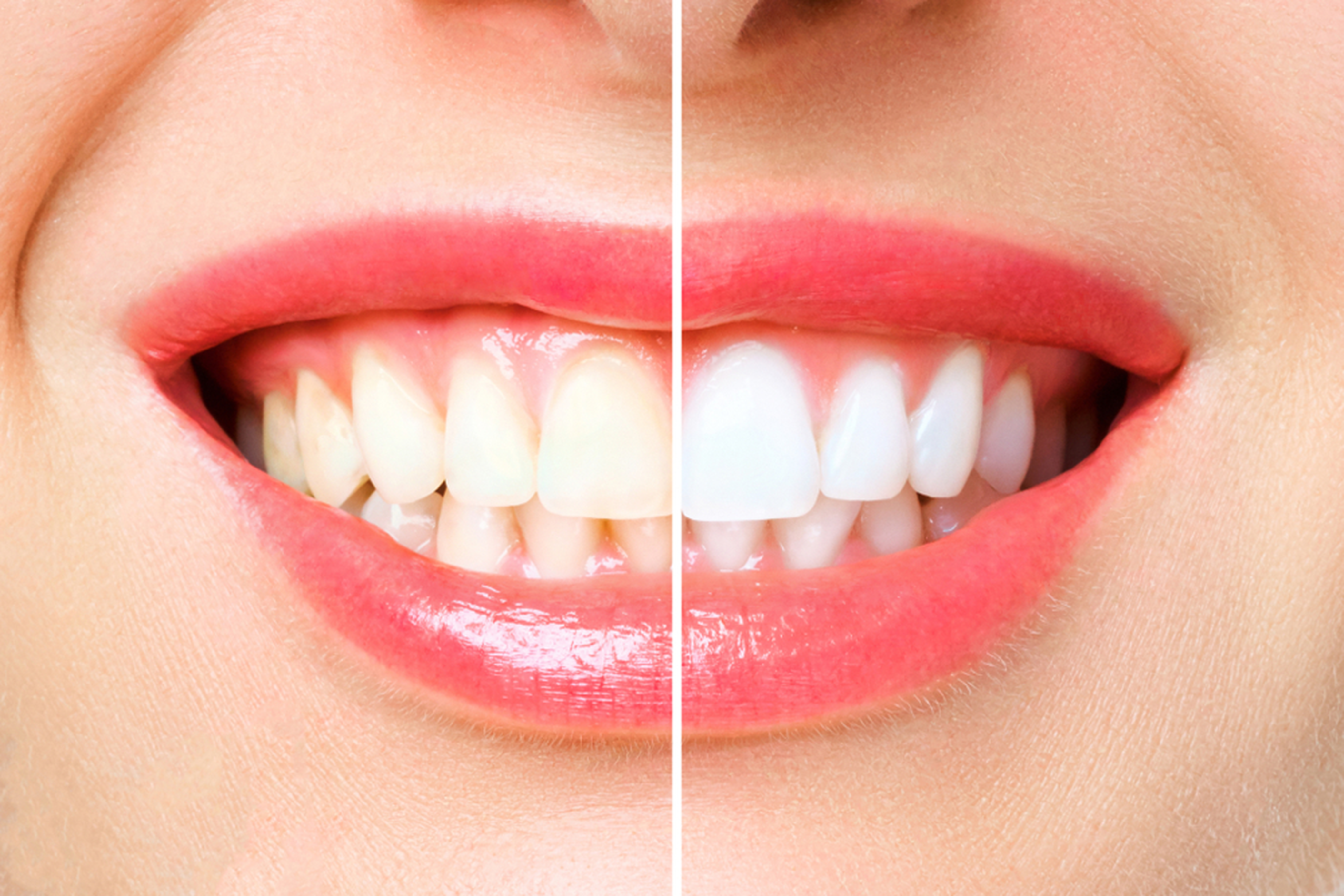 everything you know about teeth whitening