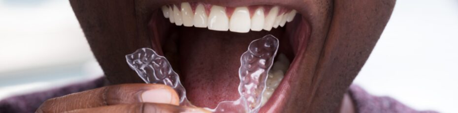 does invisalign improve your smile