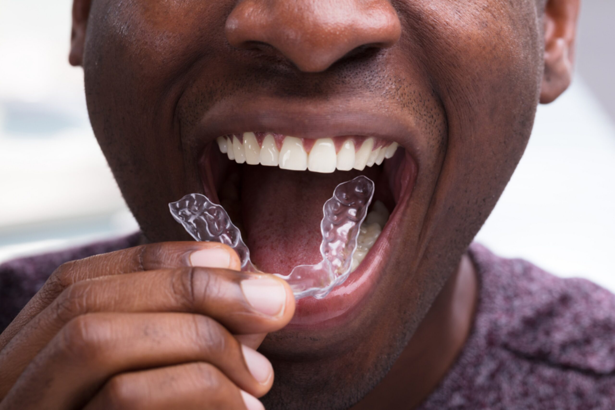 does invisalign improve your smile