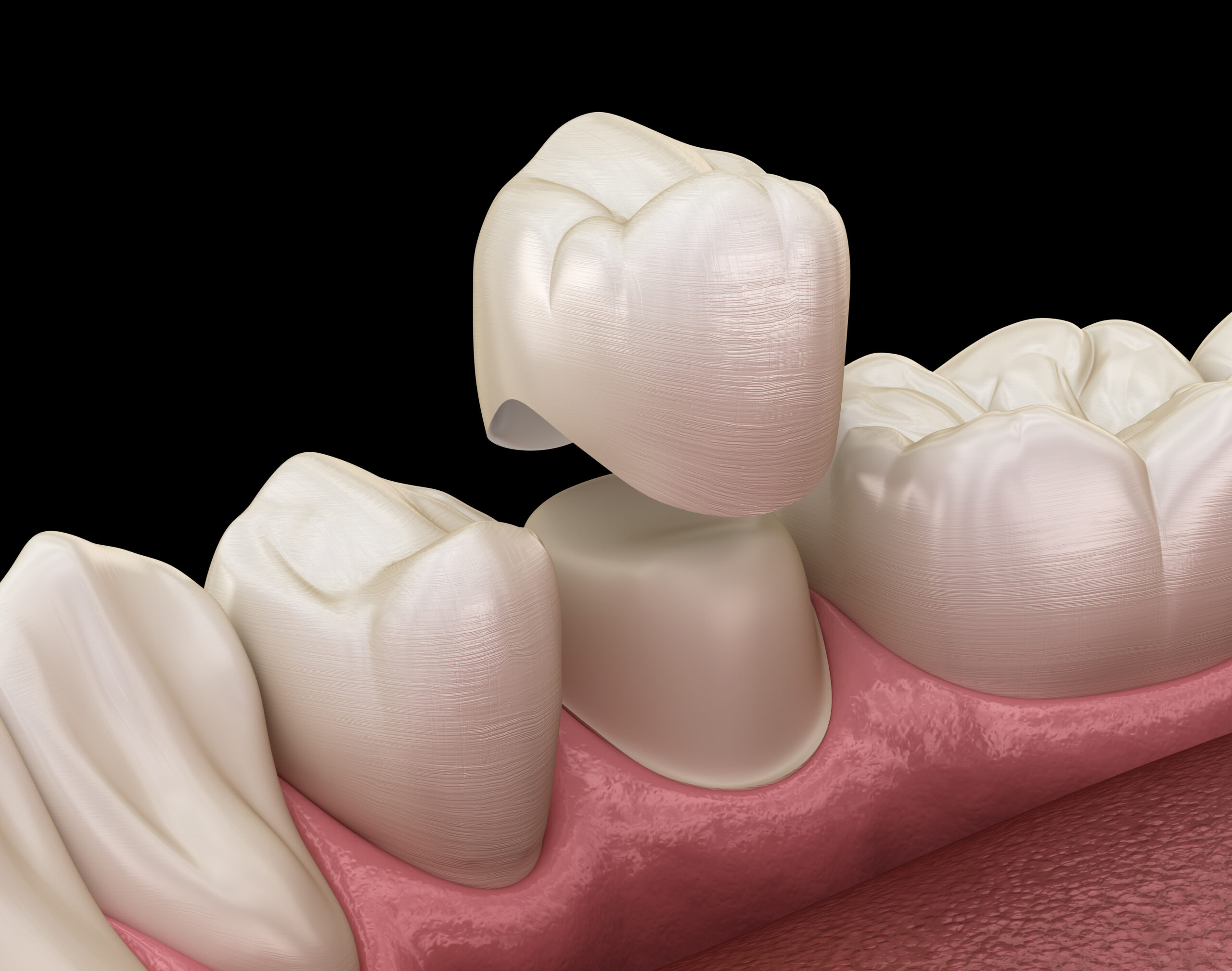 how to care for your dental crowns tips for longevity